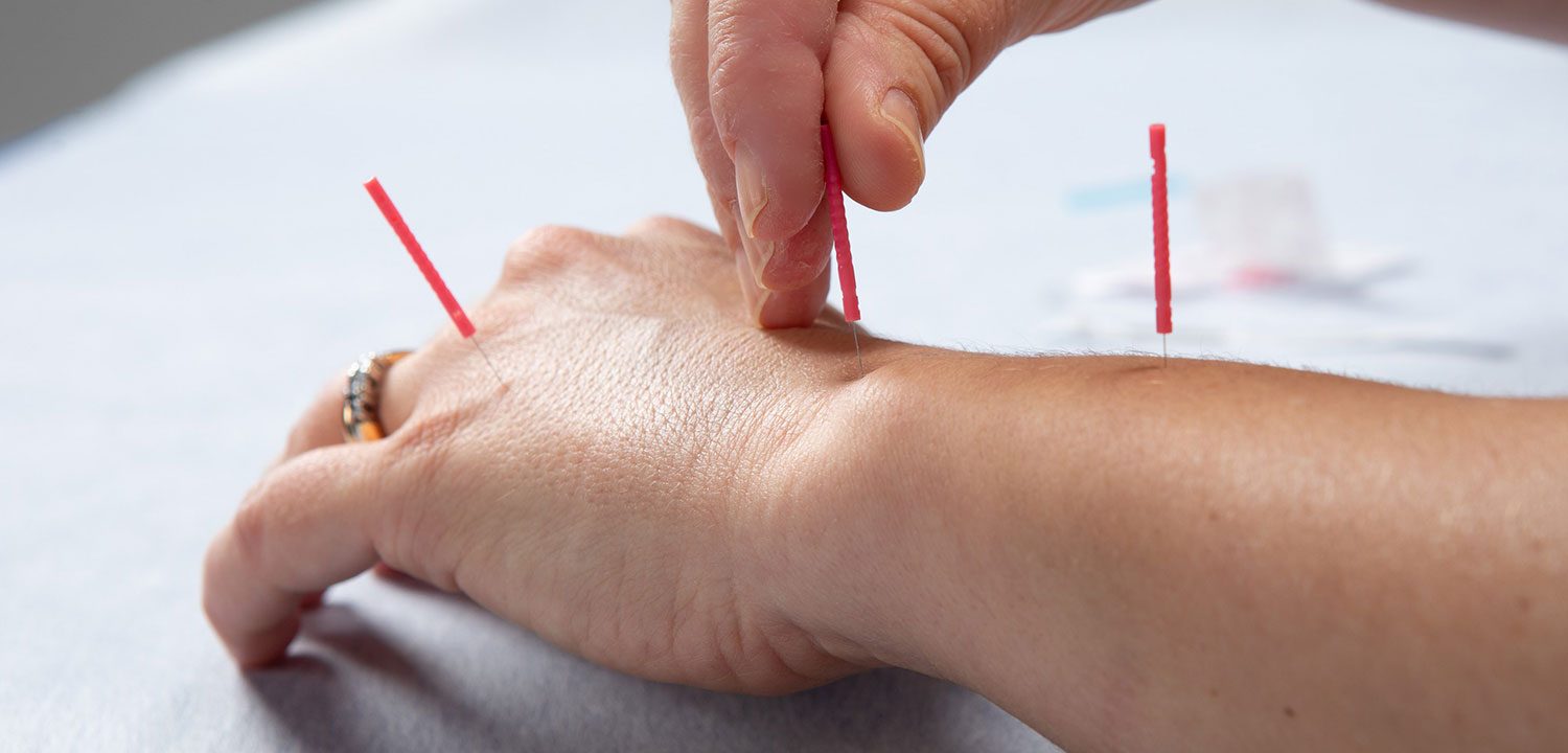 Akupunktio annetaan naisen käteen kolmella neulalla.